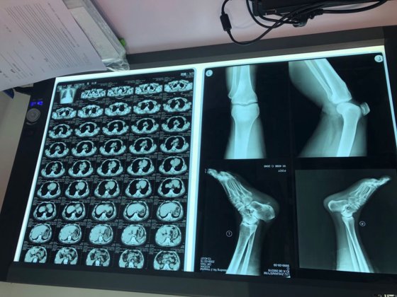 X 線 LED トリプル フィルム