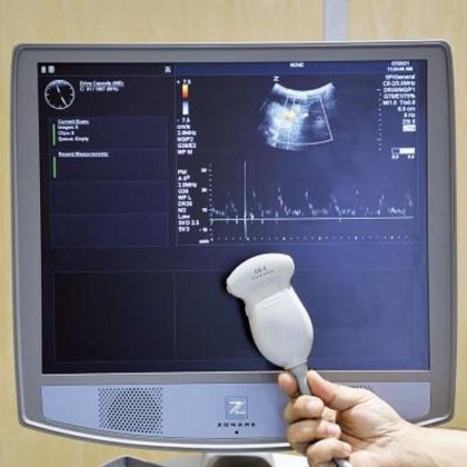 マインドレイ ゾナーレ超音波