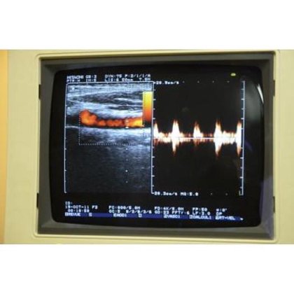 日立オデッシー エコードップラー超音波