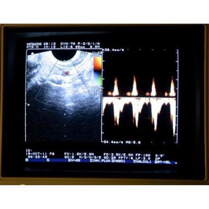 日立オデッシー エコードップラー超音波