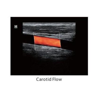 迈瑞Z5彩色多普勒系统