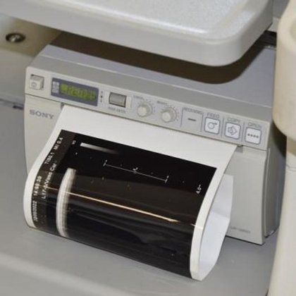 フィリップス IU22 超音波