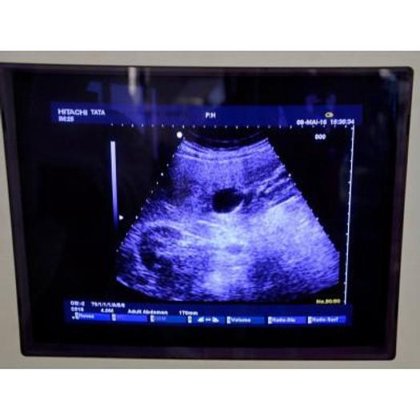 日立アルファ EUB-6500F カラードップラー超音波